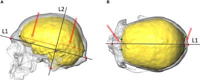 The Internal Cranial Anatomy of a Female With Endocrine Disorders From a Mediaeval Population